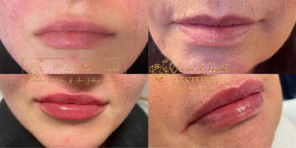 What are the trends with lip filler in 2026 and how big is too big?